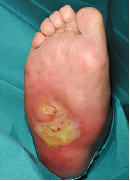 Figure 4. Severe infection