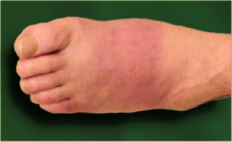 Image: A hot red foot in acute Charcot neuro-osteoarthropathy