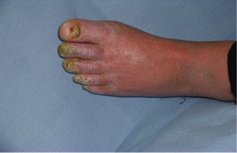 Onychomycosis with nail dystrophy